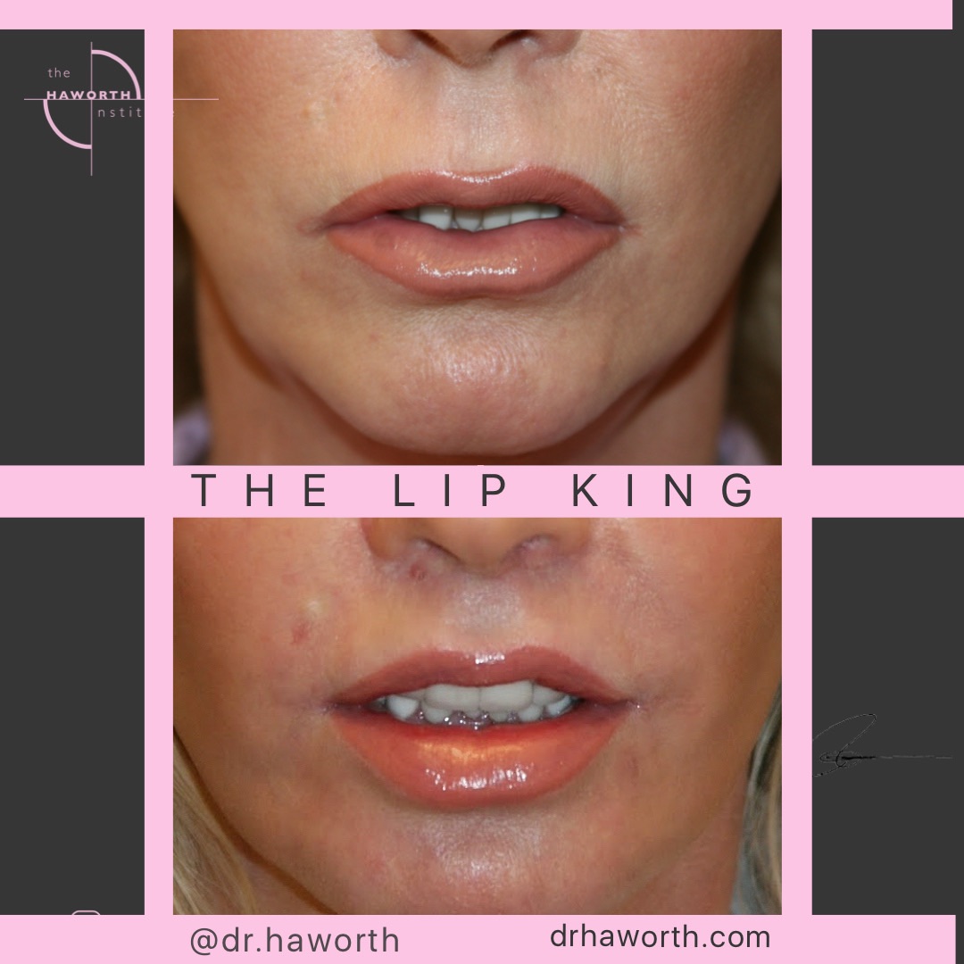 I always customize a 👄 lip reshaping design for each 🧍🏻‍♀️🧍🏼individual patient.. For this wonderful patient who also underwent total facial rejuvenation, included an upper lip lift, corner lip lifts and finally a lower V2Y plasty. She is 6 weeks out after surgery. #DrHaworth