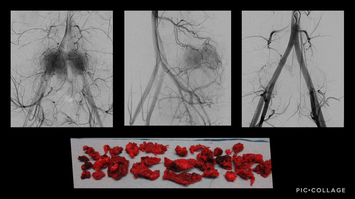 UofWa_IR's tweet photo. #PedsIR Post!
Adolescent with #Osteoblastoma -- #surgery requested pre-op #embolization➡️particle #embo➡️resection
#withoutascalpel ➡️ #withascalpel
💜💛#teamwork #collab #multidisciplinary #YouW
#twittIR #IRad #IRadRes #IamIR #MedTwitter #RadRes
@UWRadiology @seattlechildren https://t.co/hxskttr4eT