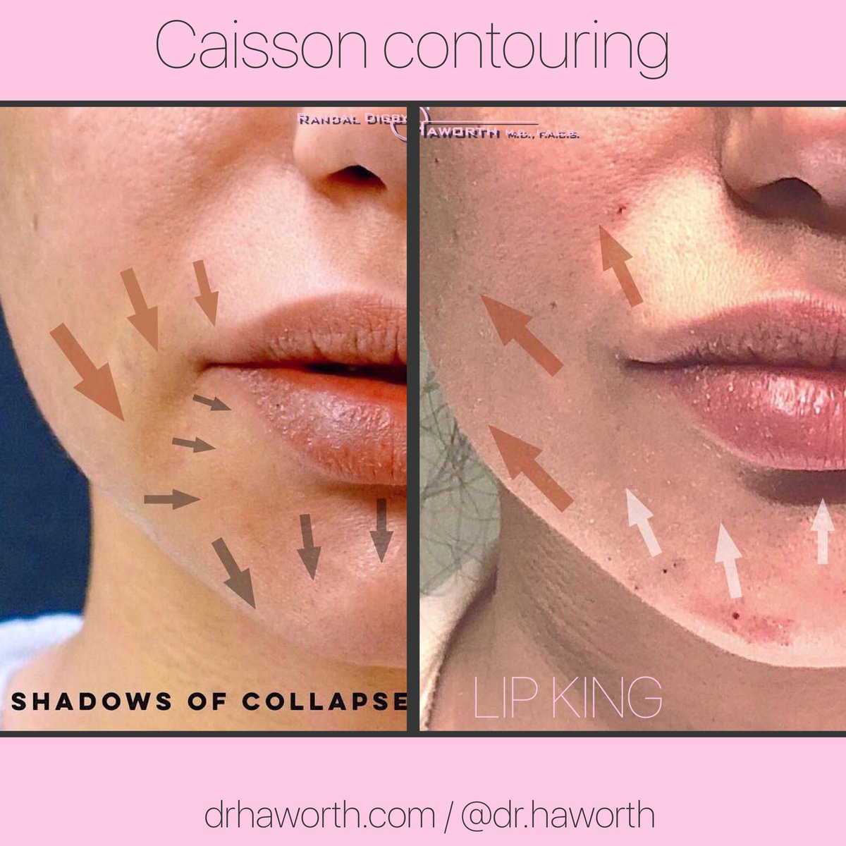 This is a split face before and after of her right face IMMEDIATELY after revolutionary CAISSON technique 🏗to rejuvenate and beautify the lower lip/chin complex💋. #Caisson technique provides support and therefore elevation. #DrHaworth 

🌐 drhaworth.com