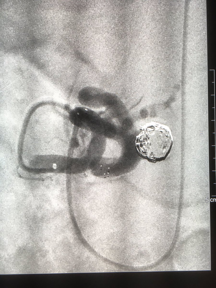 Transradial stent-assisted coiling of a wide neck splenic artery aneurysm using Sofia and Solitaire AB. When INR goes IR 😉