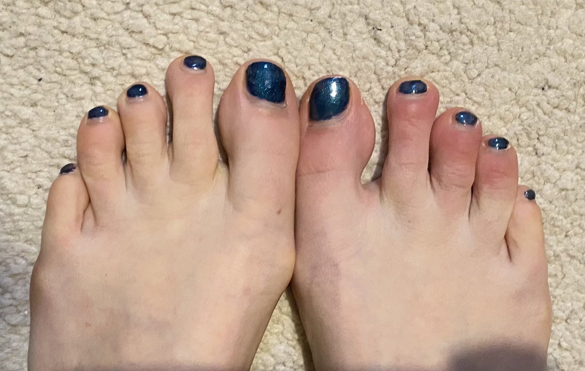 Jordan24255152's tweet photo. I had a positive covid test three weeks ago and last week my toes started showing the signs of #covidtoe AGAIN and they are sore, red/discoloured, swollen and slightly numb... this virus has a personal vendetta against me 😫😂 https://t.co/0BFDd6rbSj