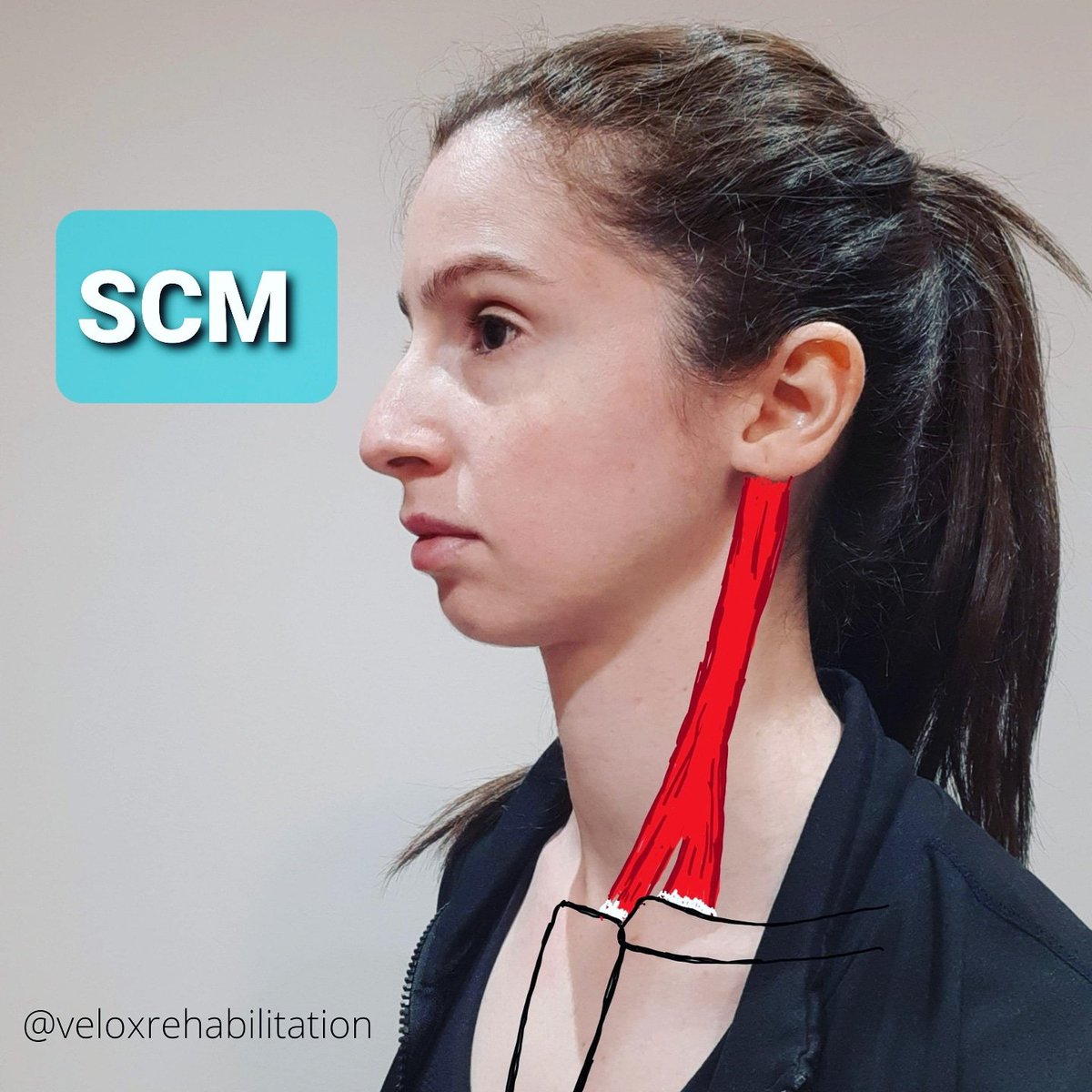 vrogovskyPT's tweet photo. Sternocleidomastoid (SCM)
This muscle can cause headaches at your eye, front and top of your head, a throat tightening sensation, nausea, dizziness, lack of coordination (dysmetria) and a feeling of fullness your ear 🥴
#physiotherapist #physiotherapy #Vaughan #woodbridge #maple https://t.co/QofT40YzyL
