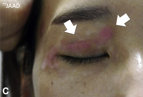 Suberythemic and erythemic doses of a 308-nm excimer laser treatment of stable vitiligo in combination with topical tacrolimus: A randomized controlled trial bit.ly/2Hbmuhg