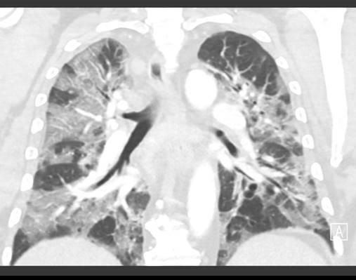 mfldclinic's tweet photo. The image on the left is a scan of healthy, normal lungs. The image to the right shows the intense inflammatory response related to COVID-19. These are real scans from our hospitals. So please wear a mask, practice social distancing and do your part to help reduce the spread. https://t.co/xMAixI73DB