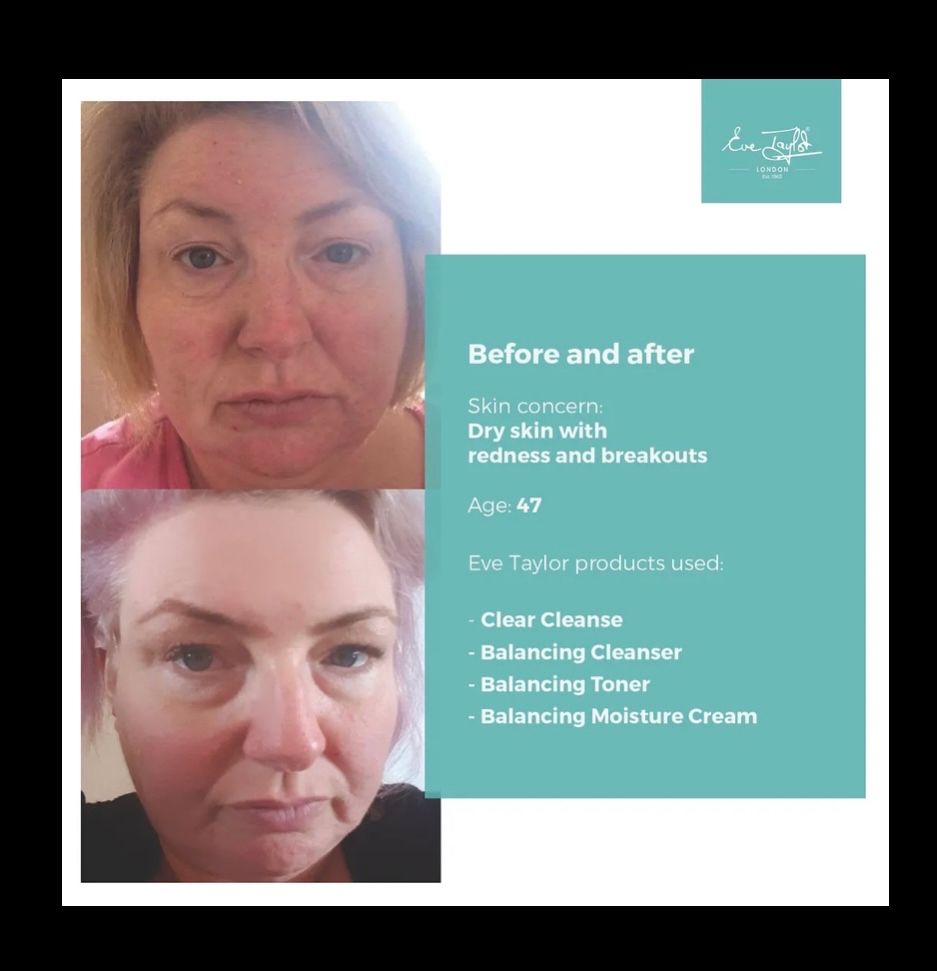 Do you suffer with dry reddened skin ?
If so then the balancing range is just what you need! 
Get in touch for your online personalised skin consultation now on 07979366317
#evetaylor #evetaylorlondon #evetaylorproducts #evetaylorskincare #evetayloressentialoils #hambrook #bosham