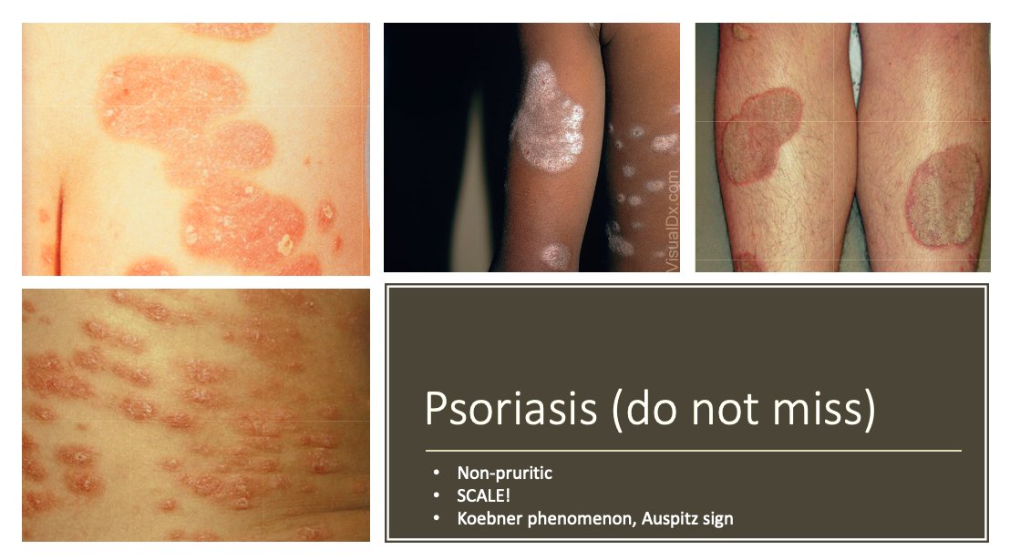 plaque psoriasis amboss