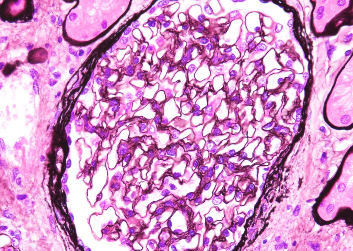 JeanHouMD's tweet photo. Struck down by steroids:  25 yo male with history of anabolic steroid use for over 5 years, bx'ed for proteinuria and worsening renal function.  Advanced FSGS with severe parenchymal scarring (45% global and 40% segmental sclerosis), glomerulomegaly, partial FPE.  JUST SAY NO!!!! https://t.co/QuUimi6Dcn