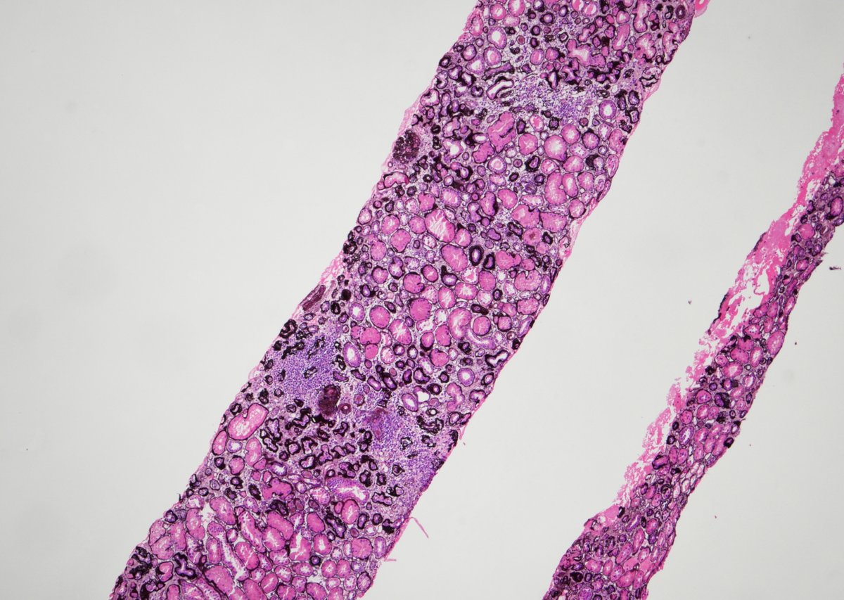 JeanHouMD's tweet photo. Struck down by steroids:  25 yo male with history of anabolic steroid use for over 5 years, bx'ed for proteinuria and worsening renal function.  Advanced FSGS with severe parenchymal scarring (45% global and 40% segmental sclerosis), glomerulomegaly, partial FPE.  JUST SAY NO!!!! https://t.co/QuUimi6Dcn