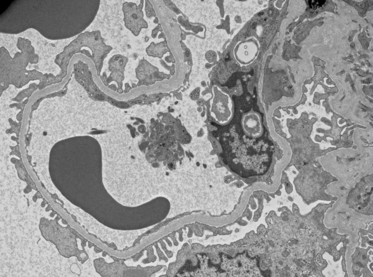 JeanHouMD's tweet photo. Struck down by steroids:  25 yo male with history of anabolic steroid use for over 5 years, bx'ed for proteinuria and worsening renal function.  Advanced FSGS with severe parenchymal scarring (45% global and 40% segmental sclerosis), glomerulomegaly, partial FPE.  JUST SAY NO!!!! https://t.co/QuUimi6Dcn
