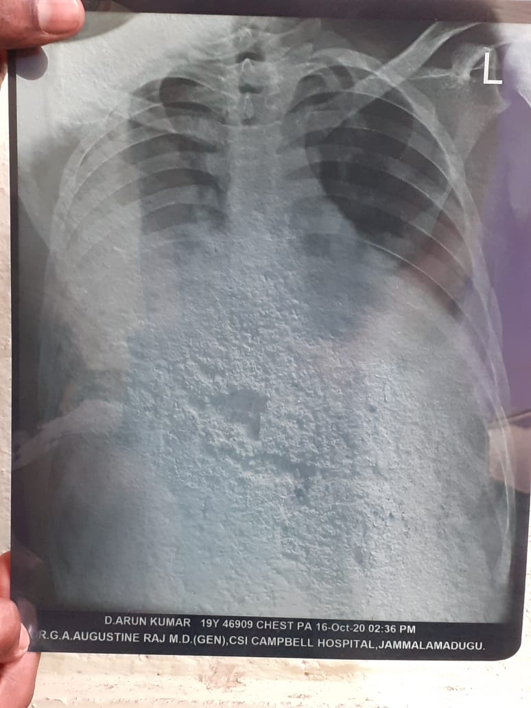 gokulavivek's tweet photo. Dear @SonuSood sir, 
Our Friend D.ArunKumar has been suffering from heart disease and  kidneys failure problem since march 2020.We Tried our best and Completed around 120 Dialysis tillnow. We Kindly request you to pls help him for the Treatment Sir.
Contact Num : 7670859470 https://t.co/tLdRwm7d8g