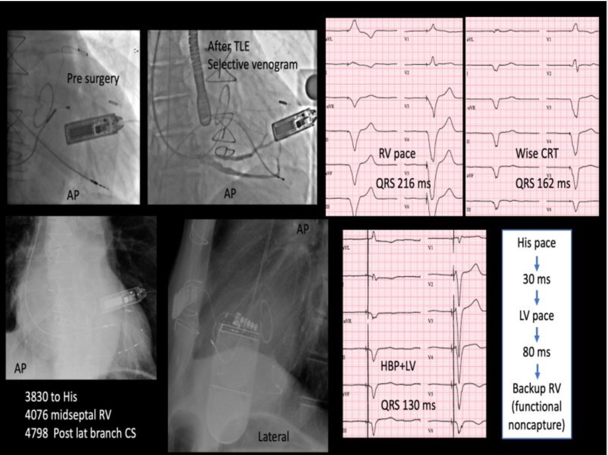 RBorgquist's tweet image. #EPeeps 75yr male, DCM, LBBB, Chronic AF, AVN ablated. Two previous suboptimal LV leads w exit-block, Wise-CRT impossible acoustic window in supine position. Amazing shortening of QRSd to 130ms with HBP+ postlat LV, after extraction of previous 4 leads. Case done w/ Dr. Mörtsell.
