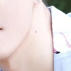 His neck mole