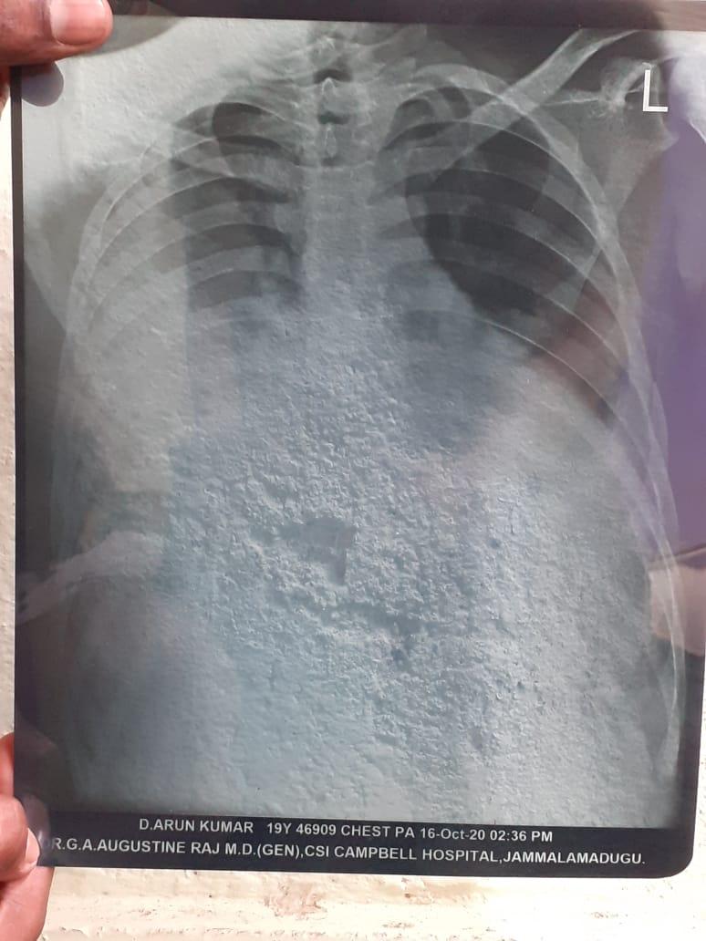 HariGundam's tweet photo. Dear @SonuSood sir 🙏
 Oue friend D. Arun Kumar has been suffering from heart disease and kidney failure problem.  Since march 2020 .we tried our best and best completed around 120 dailysis till now. We kindly request you to pls help him for the treatment sir 🙏
No : 7013744554. https://t.co/RvM2OjqtHF