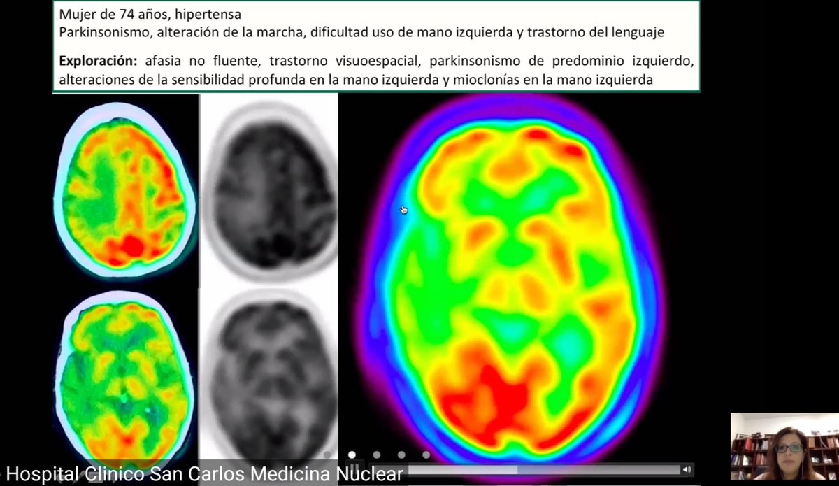 MaraNievesCabr1's tweet photo. Hoy en nuestra sesión virtual de #MedicinaNuclear del HCSC hemos hablado de la aportación de #DaTSCAN, #PET-FDG y #PET con trazadores Tau al diagnóstico de los trastornos del movimiento. #PET-FDG sin duda muy útil en la diferenciación de parkinsonismos atípicos #somosclinico https://t.co/eieMz4pgCs