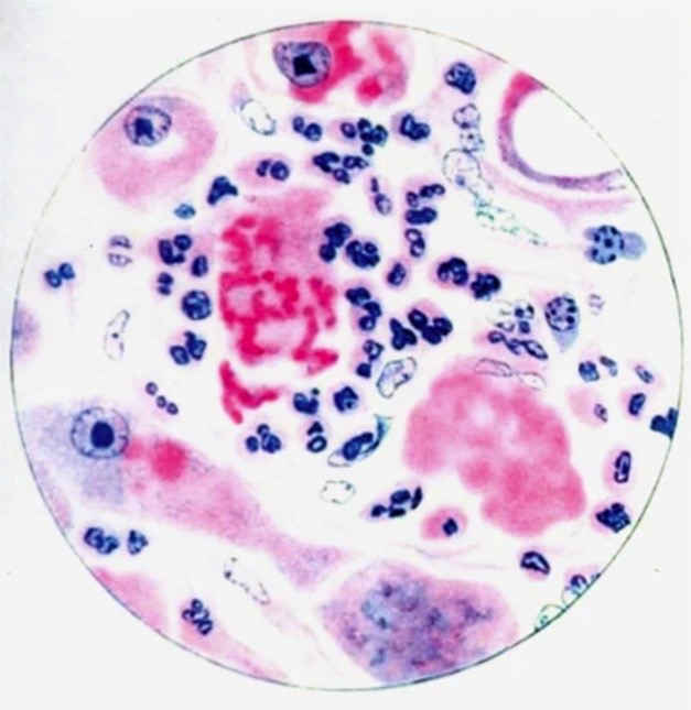MGHPathology's tweet photo. Frank B Mallory, father of Tracy B Mallory, was the editor-in-chief of the @AJPathology from 1923 to 1940.
His name is eponymously associated with the hyaline material that accumulates in the hepatocytes in alcoholic liver disease, Malloryโs Hyaline ๐ฌ๐ธโคต๏ธ
#TBT #PathThrowback https://t.co/iZeBBUujB8