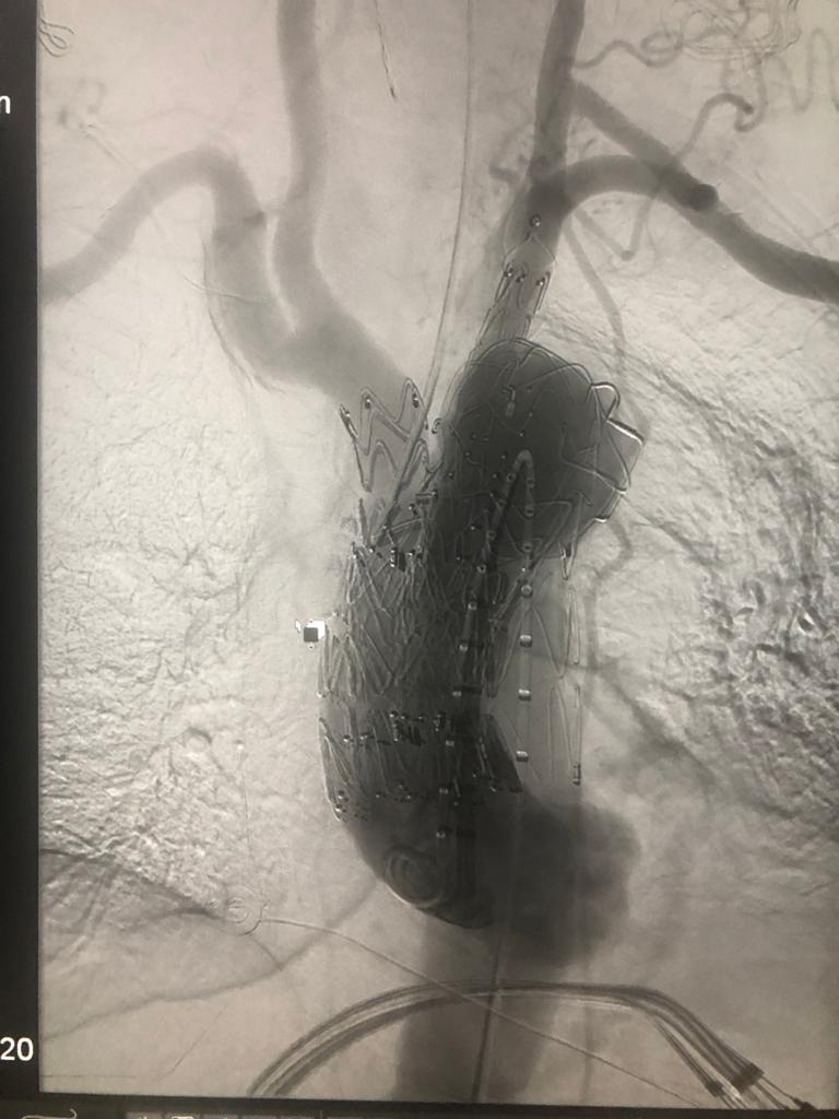 TerumoAortic's tweet photo. Congratulations to Mr. Ed Sideso, Dr. Raman Uberoi and the complex Aortic Team at @oxford_vascular and @TheOVCs on performing another successful Relay Branch case. https://t.co/sqft9dxKlo
#RelayBranch #IndividualizedSolutions #AorticRepair #AorticTeam https://t.co/NVsIvEfOem