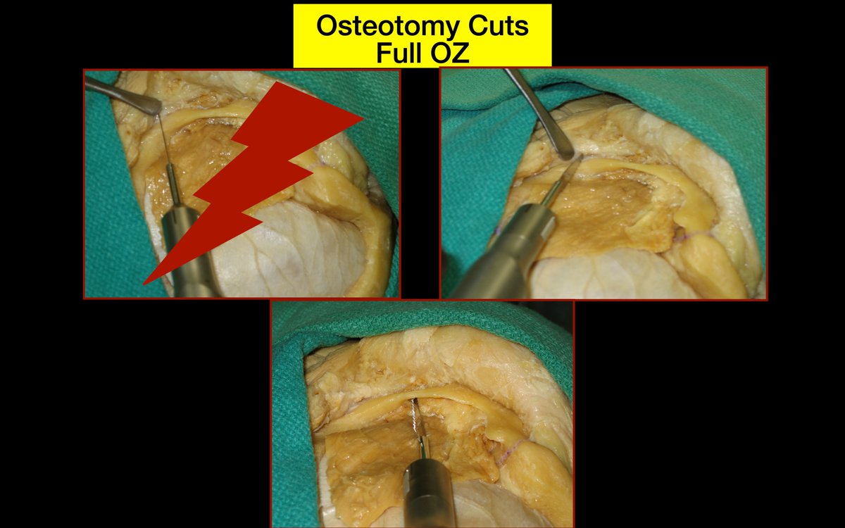 🧠 Topic: #Orbitozygomatic Approaches to Middle Fossa &amp; Cavernous Sinus 
Watch #video:
youtu.be/lg6sBS5LQdE
✅ Speaker: @MKBaskayaMD 
<a href="/NASBSorg/">NASBS</a> #SkullBase Virtual Workshop
#nsgy #neurosurgery #neuroanatomy #microsurgery #neurosurgeon #Technique #neurochirurgie #neurocirurgia