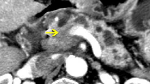 When most people say "pancreatic cancer" they mean the more common type, adenocarcinoma, which arises from the exocrine cells that aid digestionOne great vexation with this disease is that it is all too often incurable when found, either inextricable or already metastatic3/