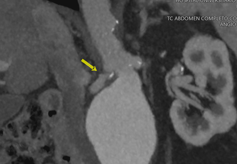 HucRadiologia's tweet photo. Aortic aneurysm with bilateral renal stenosis and short neck.
Percutaneous endovascular aortic aneurysm repair with 2 chimneys.
Gutter 4 weeks later.
There are no leaks in last CT (5 month later).

#percutaneous #withoutscalpel #interventionalradiology #CanaryIslands #Irad #CHUC https://t.co/1RPZmY3atj