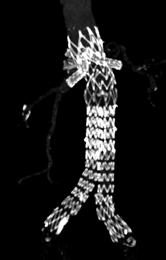 HucRadiologia's tweet photo. Aortic aneurysm with bilateral renal stenosis and short neck.
Percutaneous endovascular aortic aneurysm repair with 2 chimneys.
Gutter 4 weeks later.
There are no leaks in last CT (5 month later).

#percutaneous #withoutscalpel #interventionalradiology #CanaryIslands #Irad #CHUC https://t.co/1RPZmY3atj