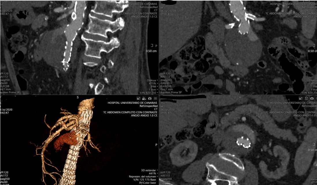 HucRadiologia's tweet photo. Aortic aneurysm with bilateral renal stenosis and short neck.
Percutaneous endovascular aortic aneurysm repair with 2 chimneys.
Gutter 4 weeks later.
There are no leaks in last CT (5 month later).

#percutaneous #withoutscalpel #interventionalradiology #CanaryIslands #Irad #CHUC https://t.co/1RPZmY3atj