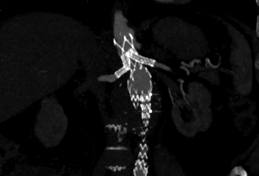 HucRadiologia's tweet photo. Aortic aneurysm with bilateral renal stenosis and short neck.
Percutaneous endovascular aortic aneurysm repair with 2 chimneys.
Gutter 4 weeks later.
There are no leaks in last CT (5 month later).

#percutaneous #withoutscalpel #interventionalradiology #CanaryIslands #Irad #CHUC https://t.co/1RPZmY3atj