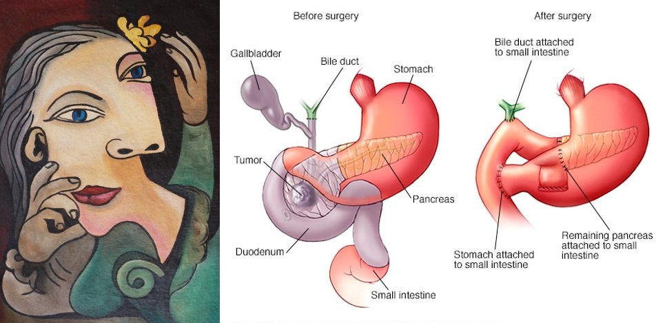 I often say that my surgeons did to my upper abdomen what Picasso did to facesIt was a near-complete rearrangement of the organs there but it successfully removed the most threatening tumor and so far has given me 3 years of continued life & work, for which I am so grateful5/