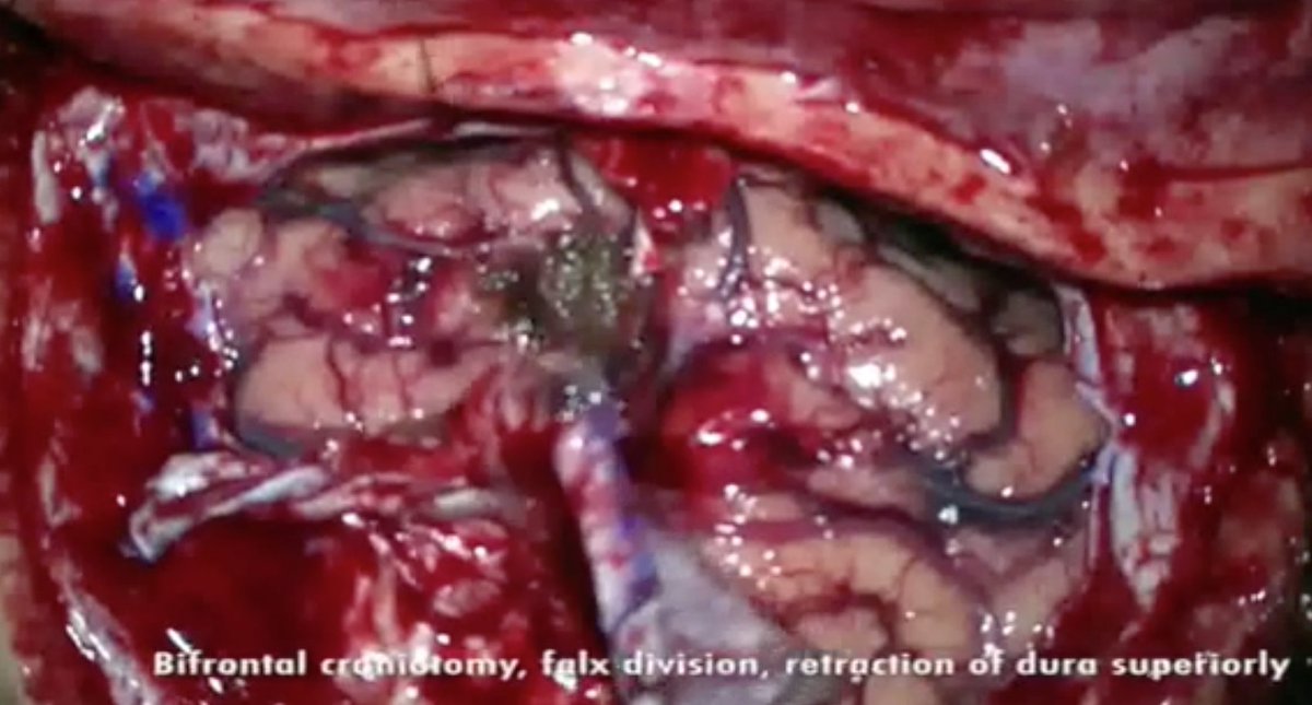 #nsgy #OpVid from Prof. Paul Gardner <a href="/PittNeurosurg/">Pitt Neurosurgery</a> demonstrating Interhemispheric, Translamina Terminalis Approach for the Resection of Suprasellar Cavernous Malformation #neurosurgery #approaches #education thieme-connect.com/products/ejour…