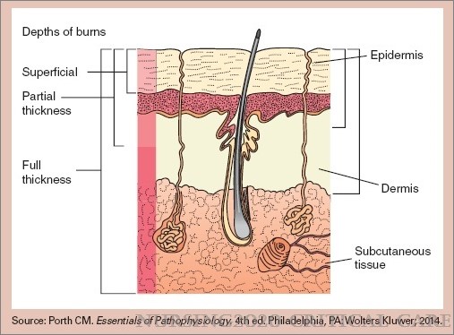 NsgCriticalCare's tweet photo. #Burninjuries in the ICU: A case scenario approach. #CriticalCare #Nursing #NurseTwitter #TBT 

https://t.co/YofRC8vNsP https://t.co/BfnQLQ1n2w