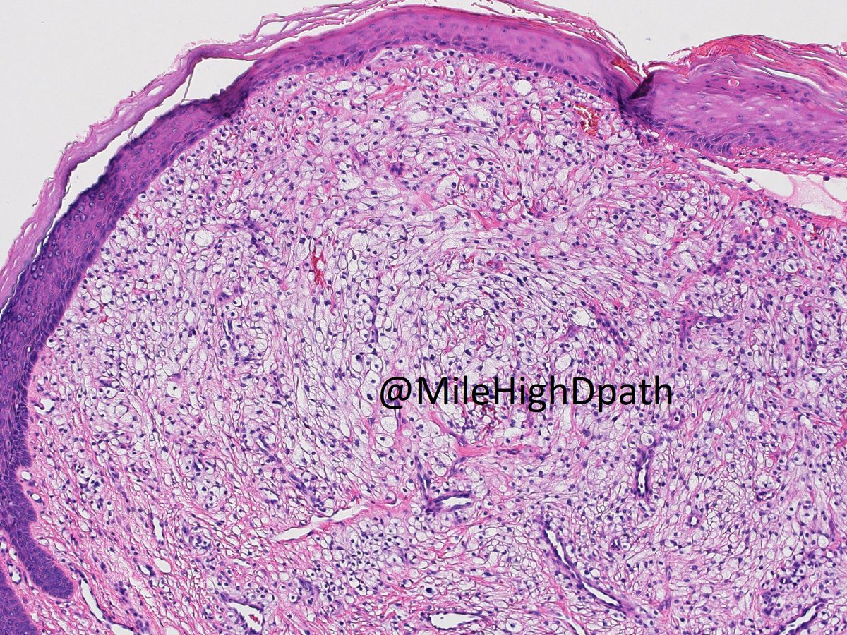 MileHighDpath's tweet photo. 43 y/o woman. Bx nose. The best diagnosis is:
A. amelanotic melanoma
B. clear cell fibrous papule
C. clear cell basal cell carcinoma
D. sebaceous adenoma
For E.C. point out something included/excluded by each stain.
#Dermpathquiz #Dermquiz #Unusualpath https://t.co/iah6lF38fZ