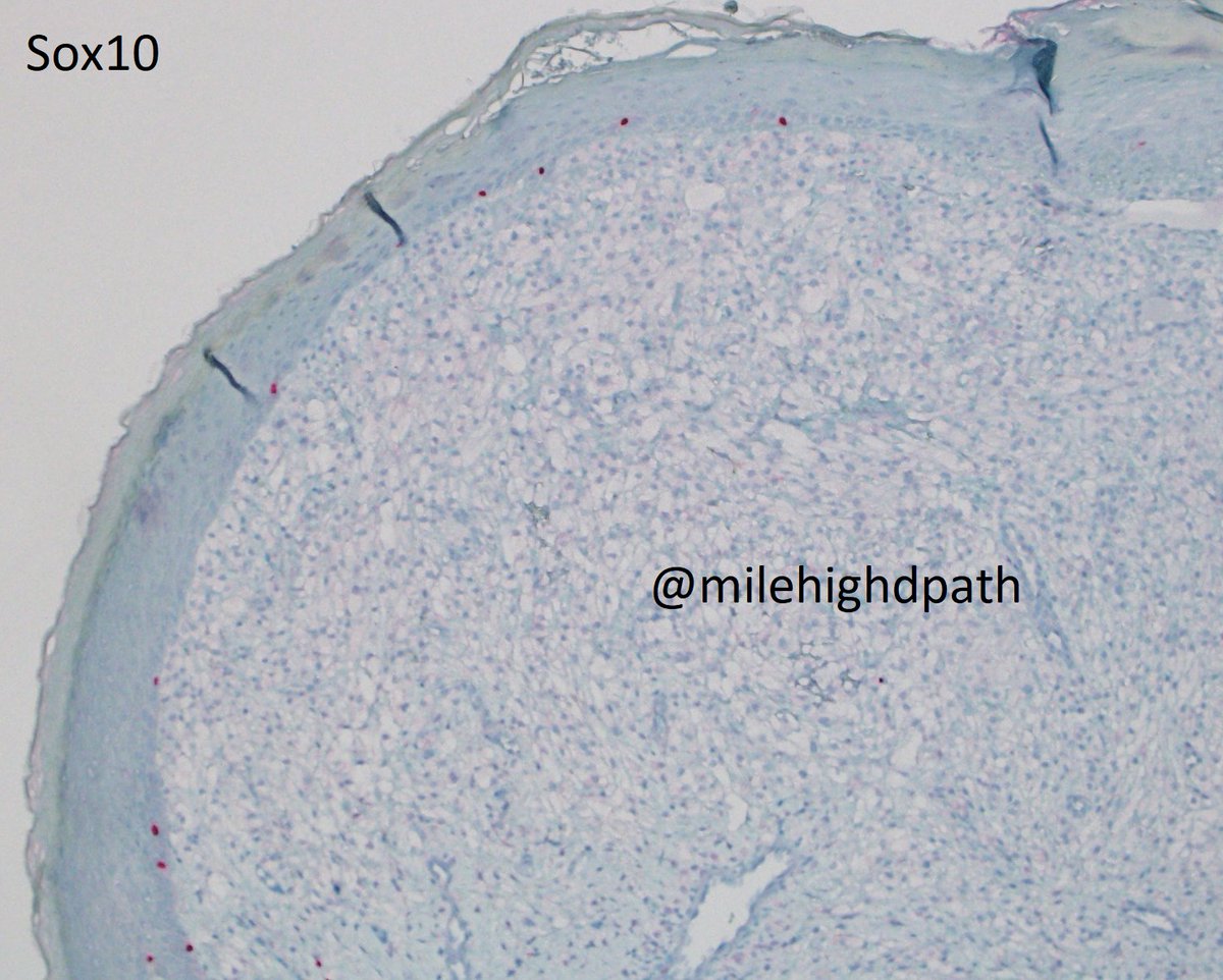 MileHighDpath's tweet photo. More IHC. 43 y/o woman. Bx nose. The best diagnosis is:
A. amelanotic melanoma
B. clear cell fibrous papule
C. clear cell basal cell carcinoma
D. sebaceous adenoma
For E.C. point out something included/excluded by each stain.
#Dermpathquiz #Dermquiz #Unusualpath https://t.co/zHRvnhsMfc