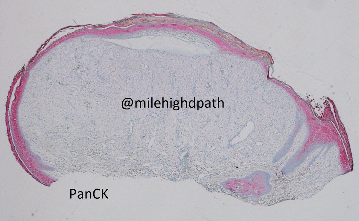 MileHighDpath's tweet photo. More IHC. 43 y/o woman. Bx nose. The best diagnosis is:
A. amelanotic melanoma
B. clear cell fibrous papule
C. clear cell basal cell carcinoma
D. sebaceous adenoma
For E.C. point out something included/excluded by each stain.
#Dermpathquiz #Dermquiz #Unusualpath https://t.co/zHRvnhsMfc