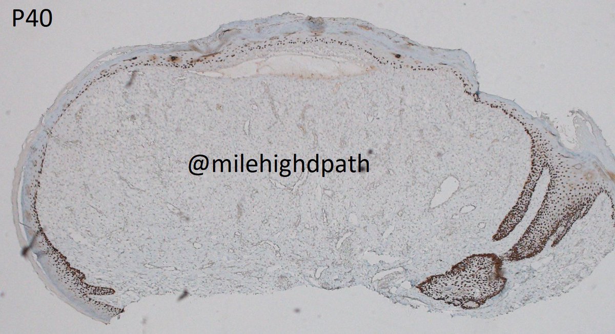 MileHighDpath's tweet photo. More IHC. 43 y/o woman. Bx nose. The best diagnosis is:
A. amelanotic melanoma
B. clear cell fibrous papule
C. clear cell basal cell carcinoma
D. sebaceous adenoma
For E.C. point out something included/excluded by each stain.
#Dermpathquiz #Dermquiz #Unusualpath https://t.co/zHRvnhsMfc