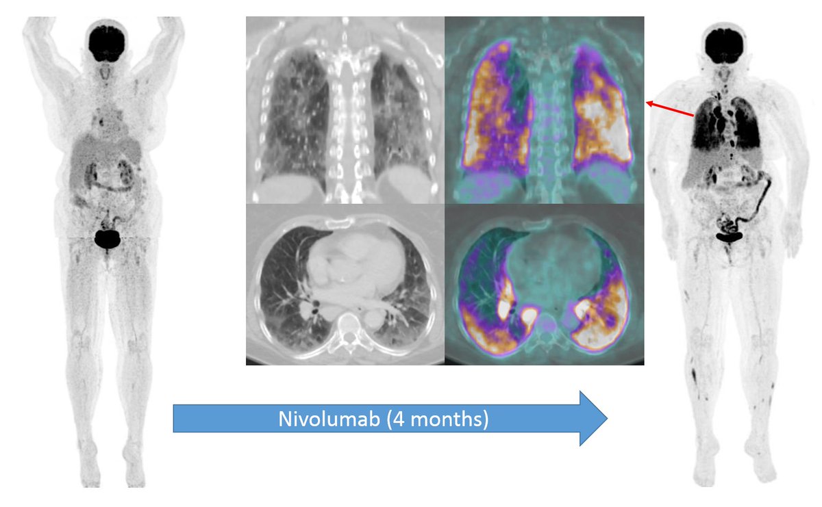 Felipe de Galiza (@felipegaliza) on Twitter photo 58yo Fem, assymptomatic, metastic melanoma treated w/ anti-PD1 Nivolumab.
FDG-PET/CT
➡️ extensive pneumonitis w/ intense uptake (immune related adverse event)
✅Diffuse alveolar damage pattern - GGO + septal thickening (worse clinical outcome)
<a href="/ICIS_News/">International Cancer Imaging Society</a> <a href="/sitcancer/">Society for Immunotherapy of Cancer</a> <a href="/jitcancer/">Journal for ImmunoTherapy of Cancer</a> 58yo Fem, assymptomatic, metastic melanoma treated w/ anti-PD1 Nivolumab.
FDG-PET/CT
➡️ extensive pneumonitis w/ intense uptake (immune related adverse event)
✅Diffuse alveolar damage pattern - GGO + septal thickening (worse clinical outcome)
<a href="/ICIS_News/">International Cancer Imaging Society</a> <a href="/sitcancer/">Society for Immunotherapy of Cancer</a> <a href="/jitcancer/">Journal for ImmunoTherapy of Cancer</a>