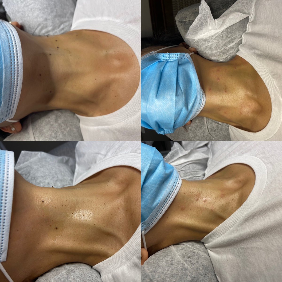 electrolysisllc's tweet photo. ‼️Skin tag removal ✅ call me or book online soon to get in before the end of the year.  #callme #electrolysis #electrologist #electrology #itworks #beauty #skincare #skin #spa #realresults #frisco #friscotx #texas #skintagremoval #skintagsremoval #skintags #skintag https://t.co/ITA9NFMy4L
