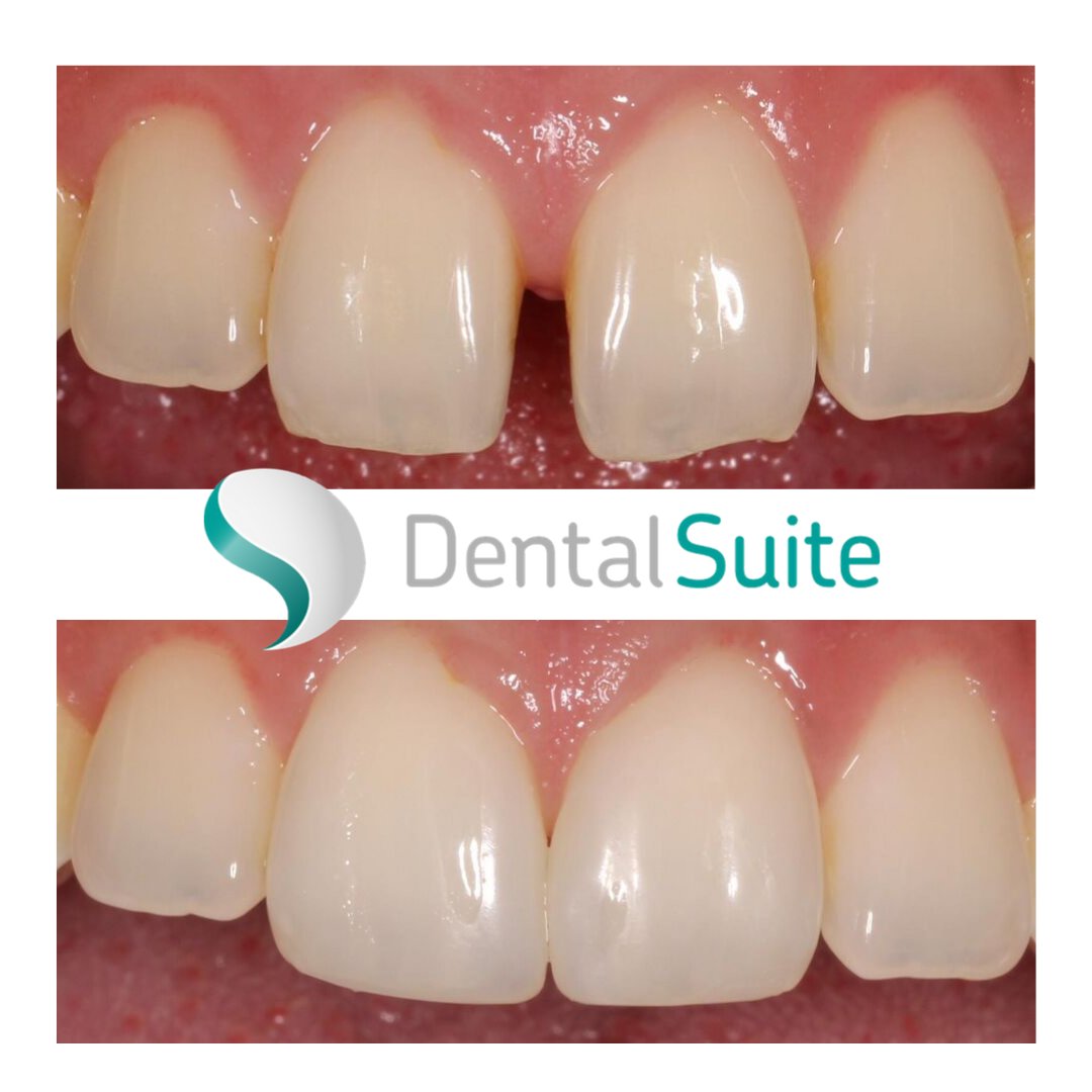 DentalSuite's tweet image. Do you have gaps in your smile that make you feel a little bit self-conscious? 🤷‍♂️🤷‍♀️ ⁣
⁣
This is an extremely common problem, and the thing is, not many people know this can be treated in just hours, just like this case by Dr Sanita Krievane! ⏱ ⁣
⁣
#toothgap #compositebonding