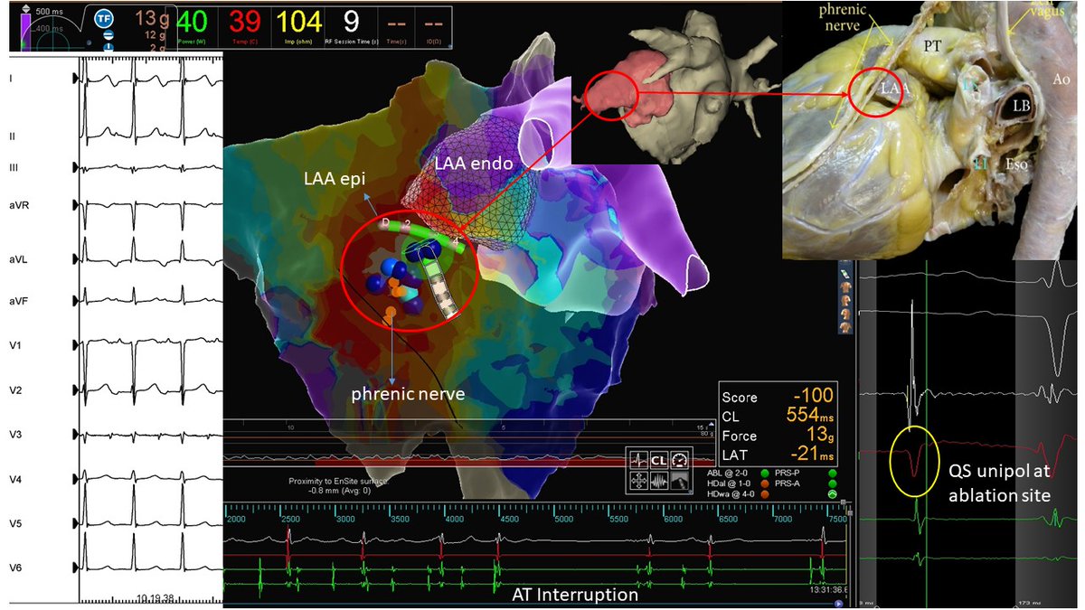 PietroRossiEP's tweet photo. Epicardial approach to ablate incessant atrial tachycardia from the left appendage. #EPeeps #fbfteam #aiac #AFib https://t.co/bnxngXZ4rq
