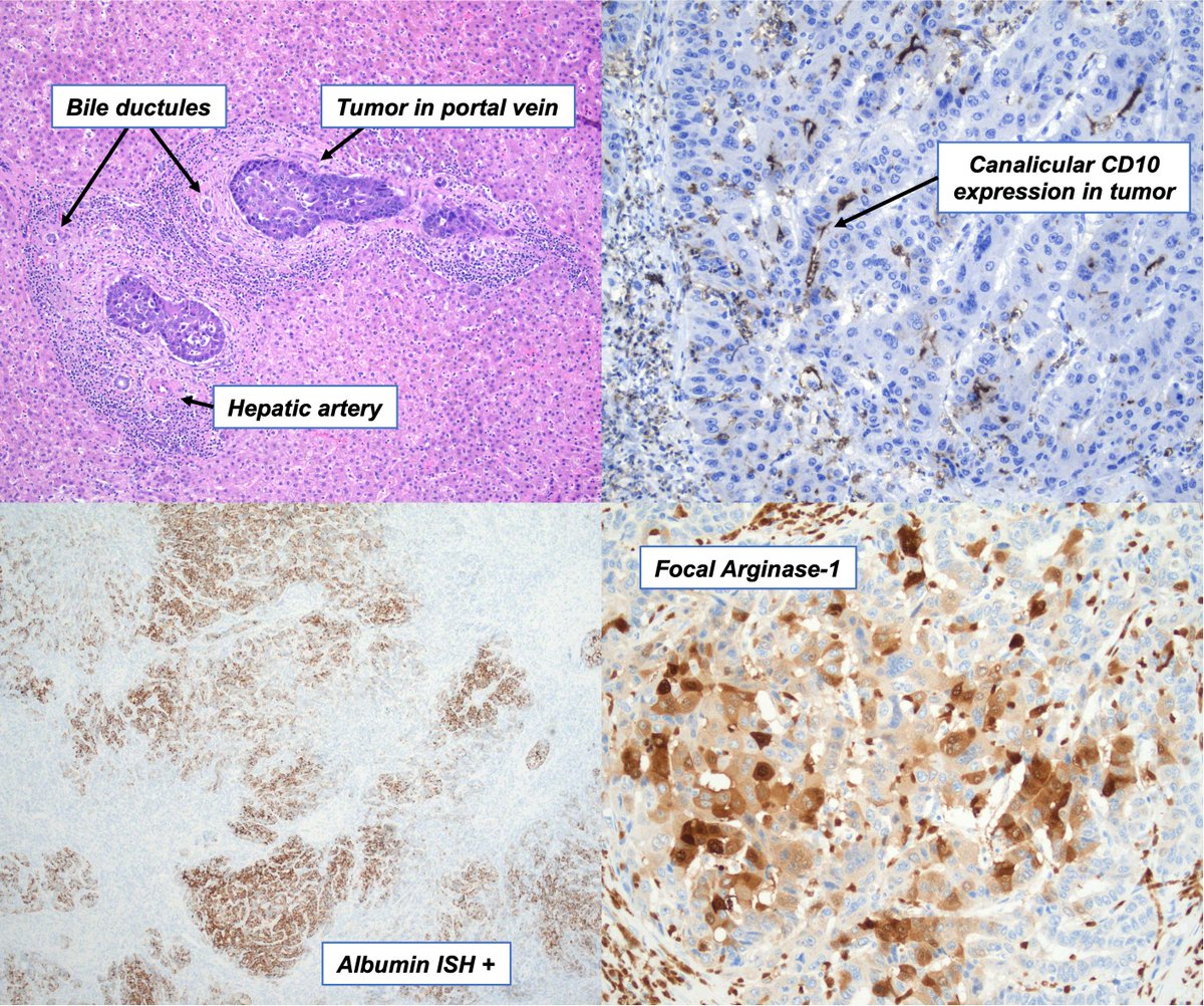 tashalarman's tweet photo. Portal triads with an unwelcome visitor! This liver mass showed a pseudoglandular growth pattern, patchy CK19/CK7, and neg AFP/HepPar1, raising concern for cholangio. However, Arginase1 and canalicular CD10 provided support for hepatic differentiation. Albumin ISH pos in either. https://t.co/UNH5mx5OvL