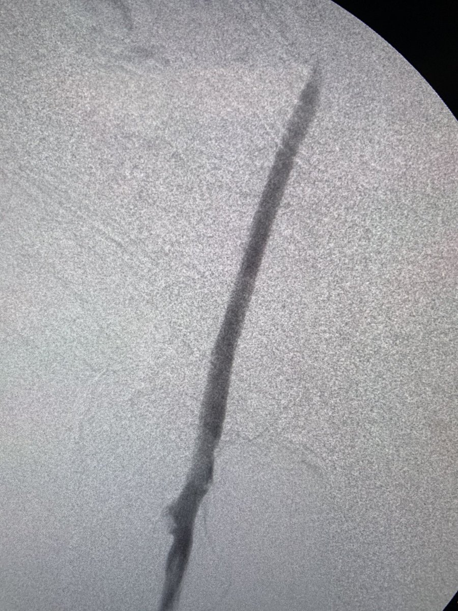 Kuldeep Singh MD (@kuldeep1926) on Twitter photo 51 F massive leg swelling, pain #DVT. <a href="/PenVascular/">Penumbra Vascular</a> Lightening 12 to the rescue no COI. <a href="/FutureVascSurgn/">FutureVascSurgeons</a> #vascular #MedTwitter <a href="/VascularSVS/">Society for Vascular Surgery</a> @VeinForum 51 F massive leg swelling, pain #DVT. <a href="/PenVascular/">Penumbra Vascular</a> Lightening 12 to the rescue no COI. <a href="/FutureVascSurgn/">FutureVascSurgeons</a> #vascular #MedTwitter <a href="/VascularSVS/">Society for Vascular Surgery</a> @VeinForum
