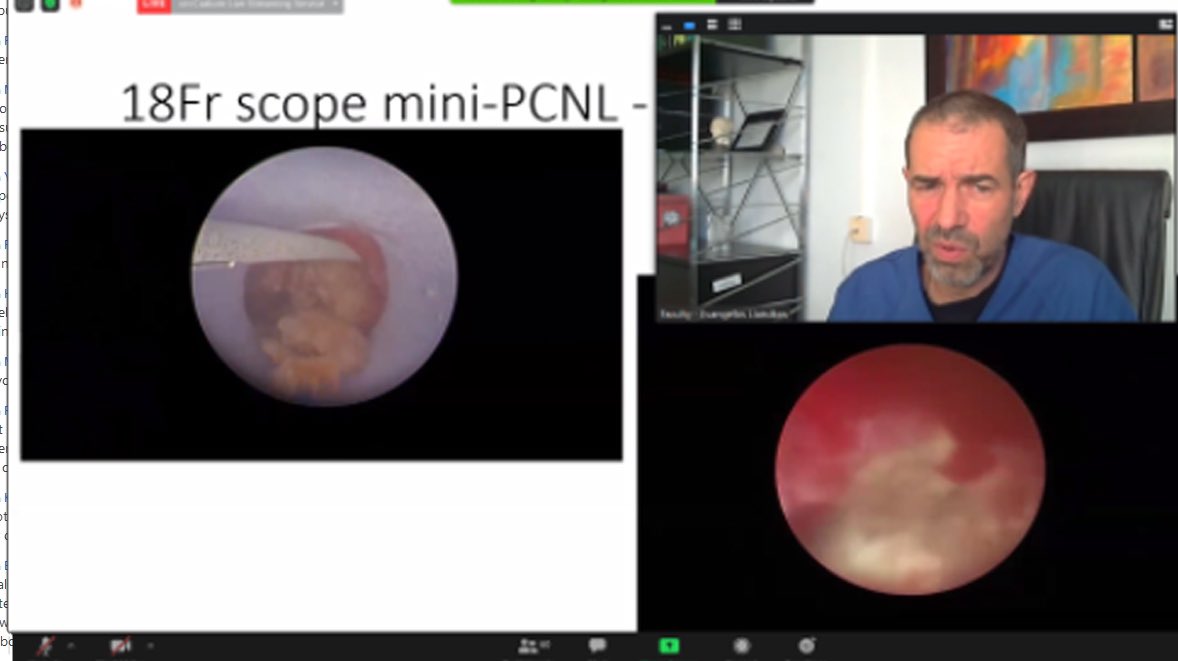quanta_system's tweet photo. What a first day at #esulasers20! Thanks @GuidoGiusti for showing an excellent #RIRS with CyberHo100 #VirtualBasket, and to @evanliats & Prof. Knoll to display different #mPCNL approaches with Cyber Ho 150 #holmium #laser. Waiting for tomorrow treatments focusing on soft tissue! https://t.co/25WsWMjPJ3