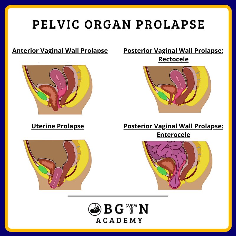 Since pelvic organ prolapse is a common condition, we need to be able to identify it and treat it effectively. Check out our infographics about types of pelvic organ prolapse, diagnosis, grading, and treatment! 🤩 

i1.wp.com/obgynacademy.c…