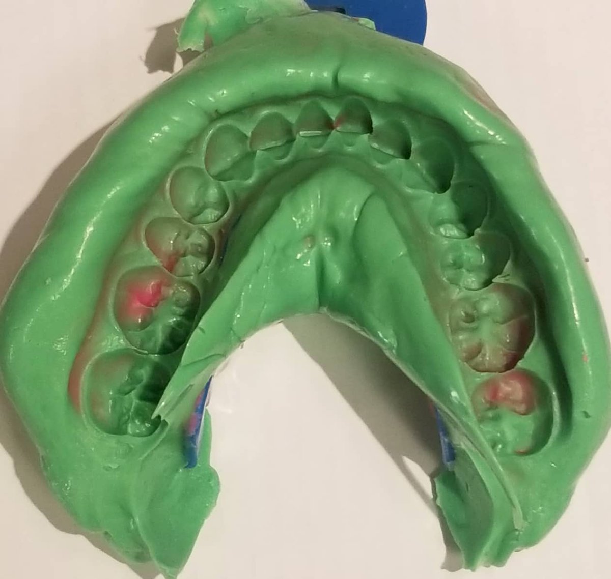 sandrareyesdds's tweet photo. #PolyVynilSiloxane #impressions for #Invisalign treatment.  Beautiful!👌

#dental #dentistry #dentist #reyesdental #ilovedoc #dentalhygiene #dentallife #dentalassistant #orthodontist #braces #invisablebraces #orthodontics #smile https://t.co/BW8H3xWx2n