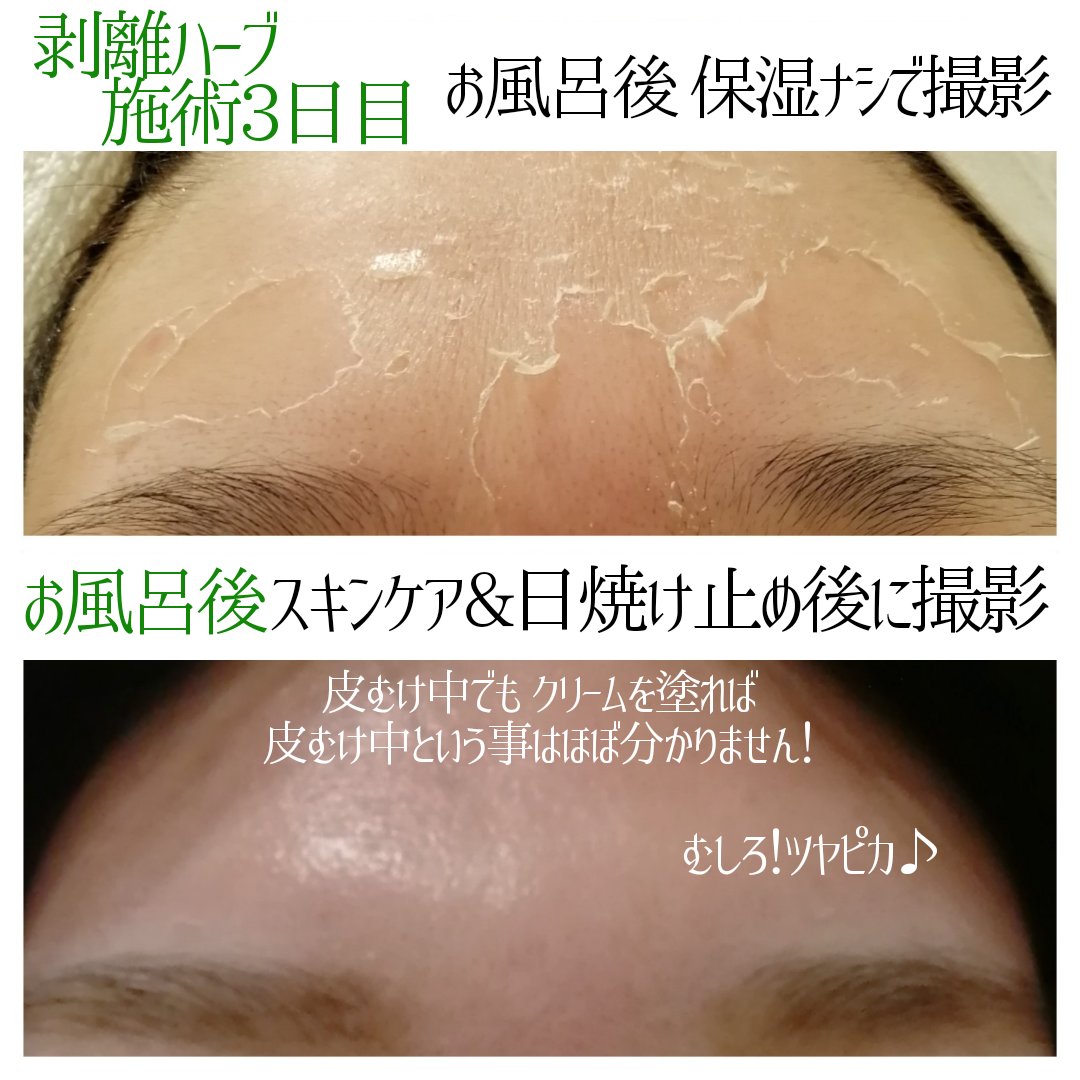 剥離中〜🌿肌質改善 皮むけするハーブピーリングで美肌まで