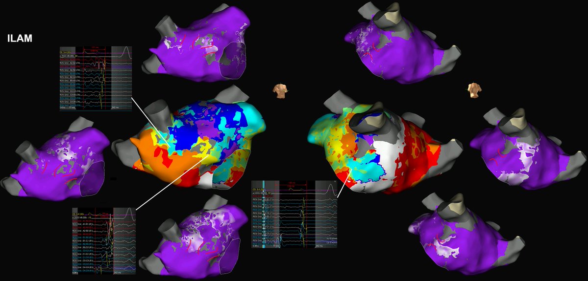 #ILAM successfully identified 3 DZs which were later confirmed to be in circuit with reentrant tachycardia induced post model creation. The ablated isthmus for the mapped tachycardia agreed with the location of one of the DZs. 
#proudtobeabbott #Epeeps
<a href="/AbbottCardio/">Abbott Cardiovascular</a>
#HDGrid