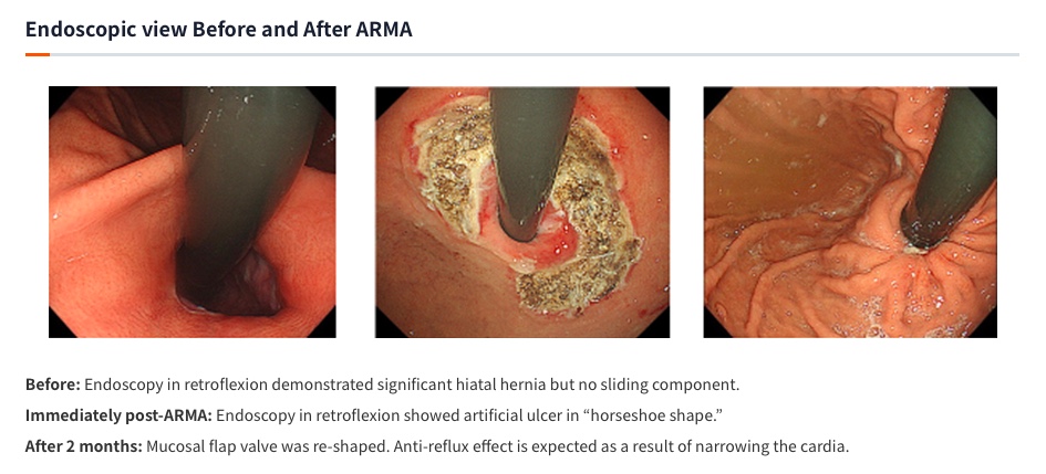 enrrikke's tweet photo. Ever heard of ARMA? 🤔 Anti-Reflux Mucosal Ablation - a novel treatment for PPI-refractory GERD by the team of Prof. Inoue 🇯🇵 Basically, APC is done in the gastric cardia to produce scar formation resulting to narrowing of the opening, and resolution of reflux 🏆 #GITwitter https://t.co/SVtENElT3z