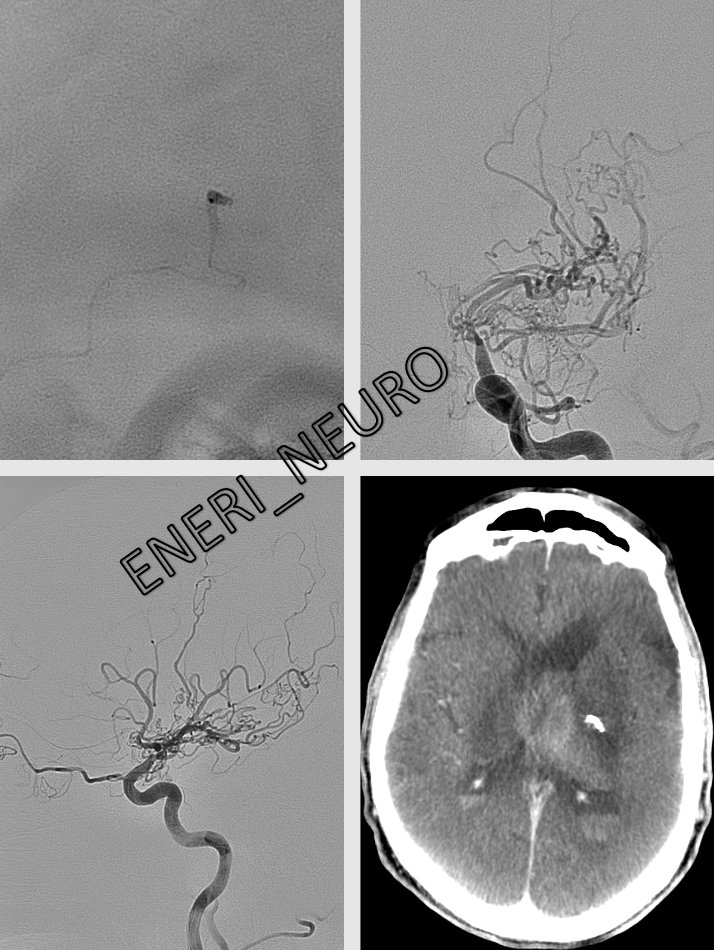 eneri_neuro's tweet photo. Ruptured deep intracranial aneurysm associated with Moya Moya disease in a 70 y.o.:
-Treated w/NBCA through radial approach
#goradial #godistal https://t.co/sqCYJriK2H
