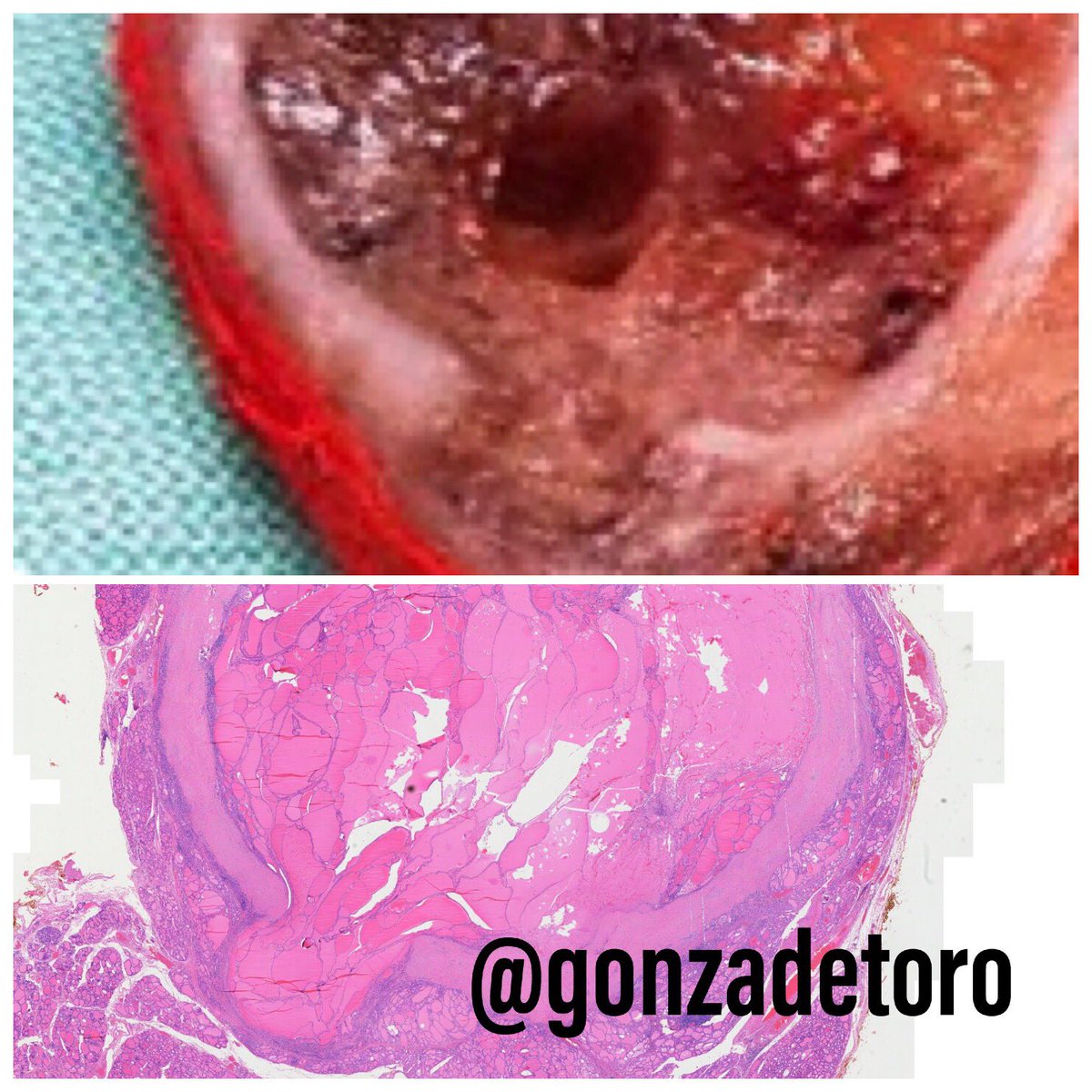 gonzadetoro's tweet photo. The histology 👀 #thyroid #HeadNeckPathology @DrAHLAMN1 @DrRolaAli @HENRYY_MD @Halima81819652 @JMGardnerMD @DrGeeONE @AlanPath @FJMazorra @AMubeen_Path @kis_lorand @MAHoureih @HeadandNeckPath @AmyHDeekenMD @PathologySayah @Histopatolomon https://t.co/8JJqO5bWnh