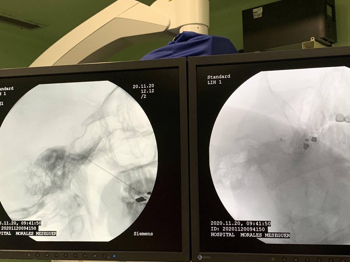 📍Hoy día de intervencionismo en <a href="/Area6VegaMedia/">Área 6 Vega Media</a> #hospitalmoralesmeseguer #ChronicPain #Gasserianganglion #thermalradiofrequency #trigeminalneuralgia