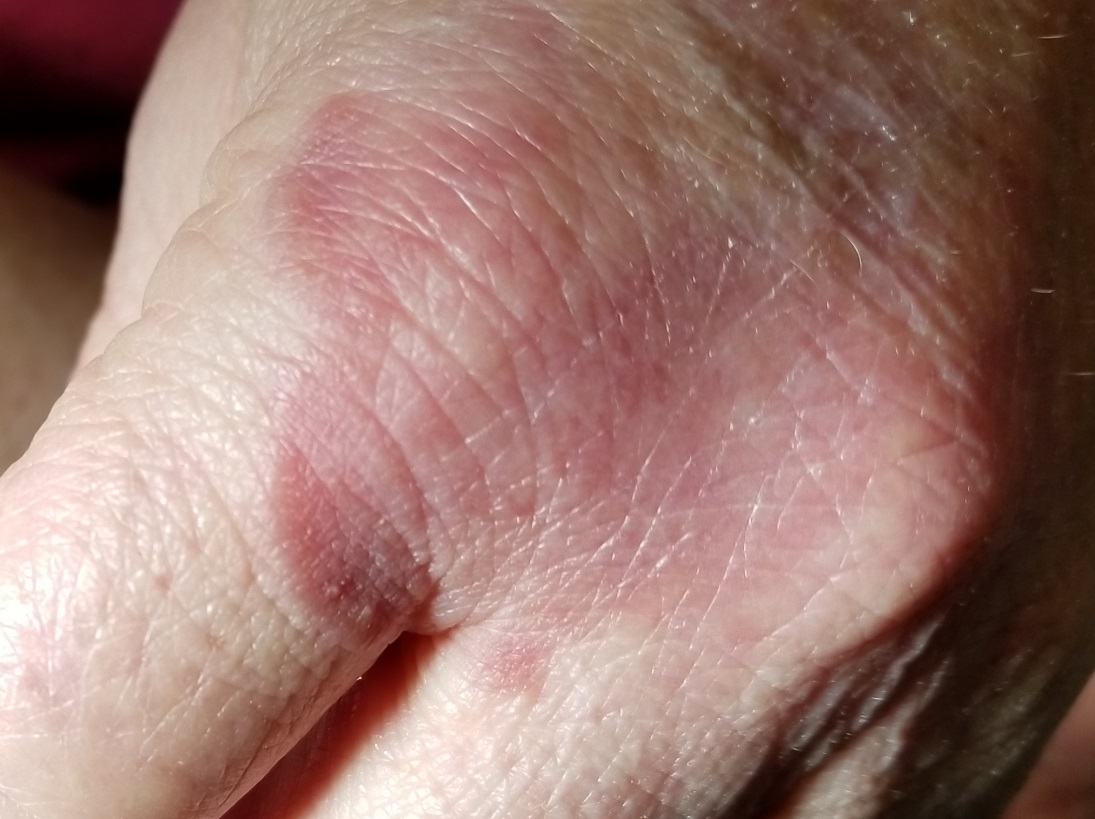 ClinRev's tweet photo. Other providers have attempted to treat the rash on this woman’s hand, but none have provided relief. Will your differential reveal the diagnosis? https://t.co/THLpnOC6vd © 2020 Clinician Reviews/Frontline Medical Communications Inc https://t.co/foE72oJ5Di