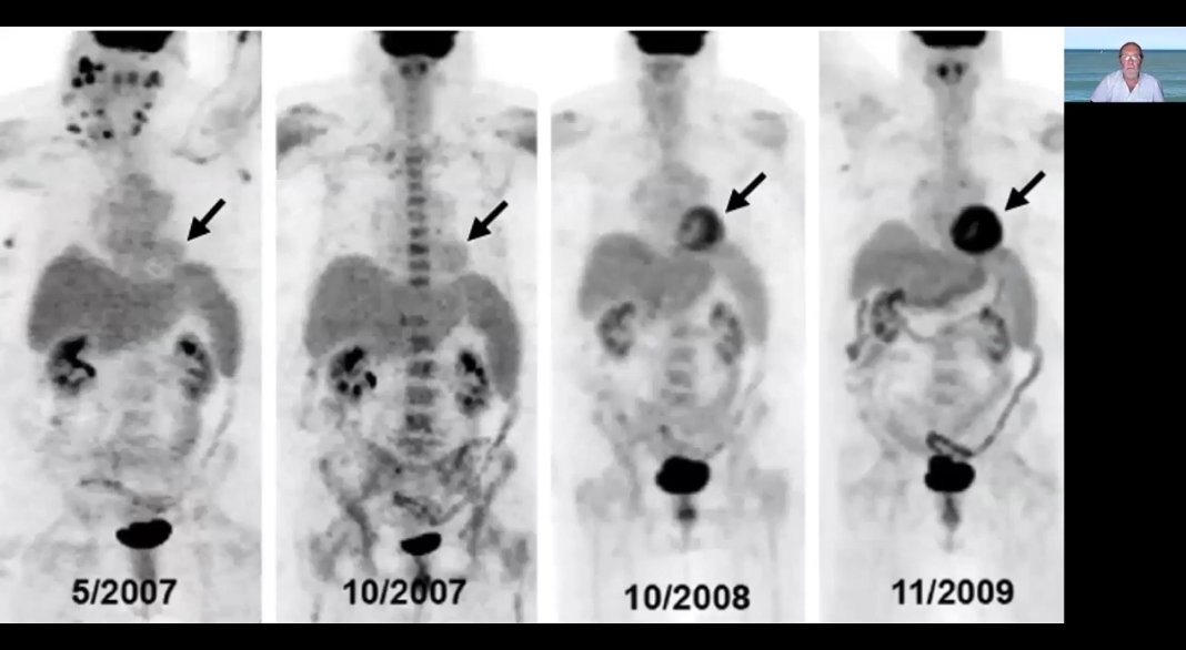SACnuclear's tweet photo. #SAC20 ⏰ #AHORA Grierson
♨️ Imagenes en el estudio de Tumores y fuentes emboligenas
🎤Dr. Marcelo Rodrigues
➡️ Valoracion de Masas Cardiacas mediante PET
#SAC20 @sac_hit @SAC_54
@SACnuclear @CardiOncoSAC #Cardionuclear @NeivaMaciel_doc
@consejoEcoSAC https://t.co/GjG1Ak4uwA